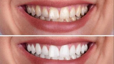 teeth whitening strips