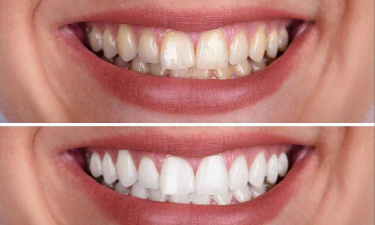 teeth whitening strips