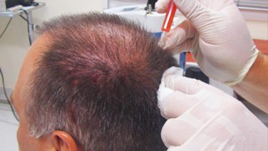 hair transplant