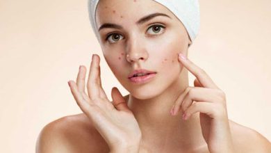 Pimples