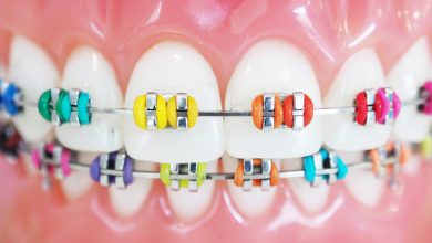 Braces color